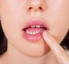 pommade de l'herpès sur les lèvres