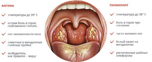 Tonsillite cronica: foto, sintomi e trattamento negli adulti
