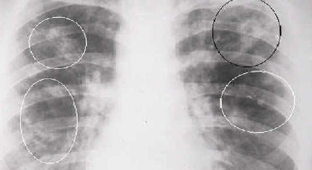 Plaušu tuberkuloze pieaugušajiem - simptomi un ārstēšana