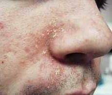 Symptômes de la dermatite séborrhéique