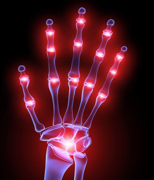 Zapalenie stawów rąk i palców: co to jest? Metody leczenia